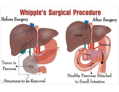 whipple-procedures-for-pancreatic-cancer